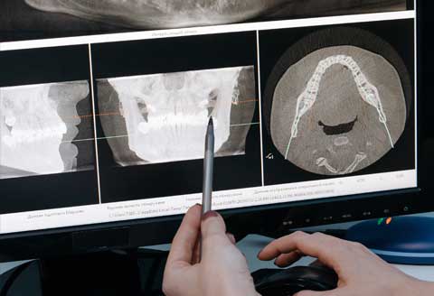 x-ray of lower jaw